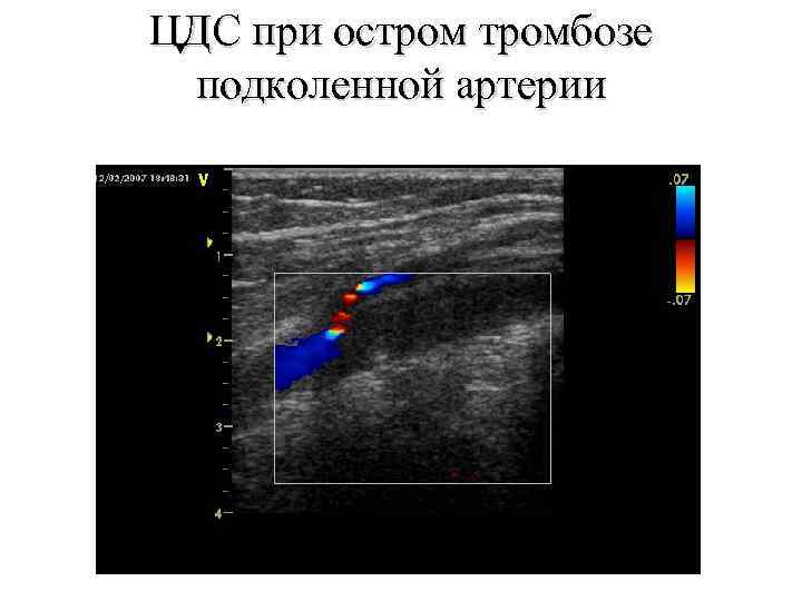 ЦДС при остромбозе подколенной артерии 