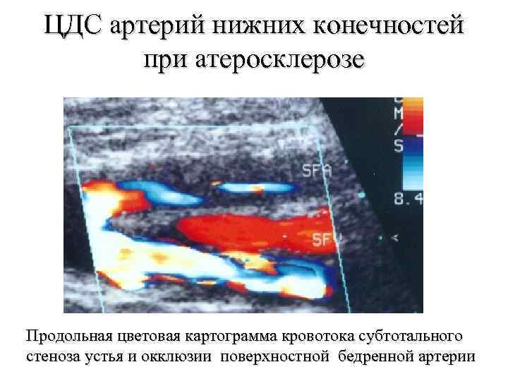 ЦДС артерий нижних конечностей при атеросклерозе Продольная цветовая картограмма кровотока субтотального стеноза устья и