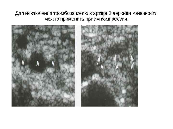 Для исключения тромбоза мелких артерий верхней конечности можно применить прием компрессии. 