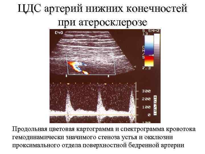 Атеросклероз нижних конечностей карта вызова