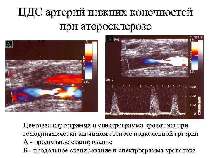 ЦДС артерий нижних конечностей при атеросклерозе А Б Цветовая картограмма и спектрограмма кровотока при