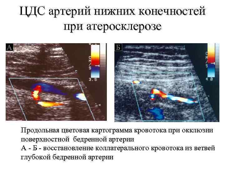 ЦДС артерий нижних конечностей при атеросклерозе А Б Продольная цветовая картограмма кровотока при окклюзии