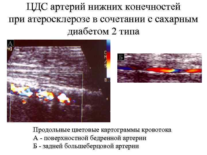 ЦДС артерий нижних конечностей при атеросклерозе в сочетании с сахарным диабетом 2 типа А