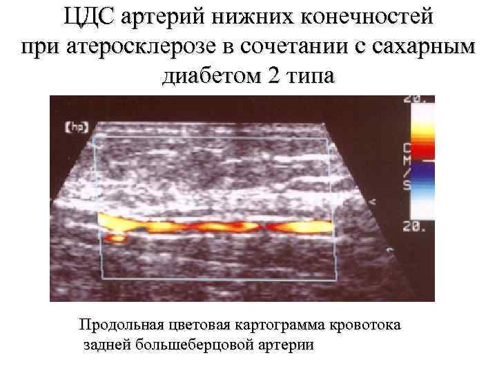 УЗИ сосудов нижних конечностей тромбоз артерий. Ультразвуковая дуплексная сканирования нижних конечностей. Протокол УЗИ облитерирующий атеросклероз нижних конечностей.