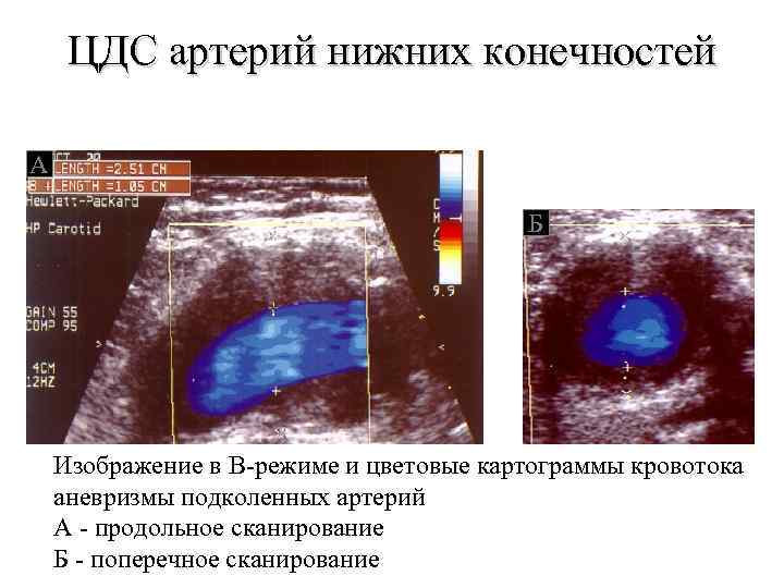 ЦДС артерий нижних конечностей А Б Изображение в В-режиме и цветовые картограммы кровотока аневризмы