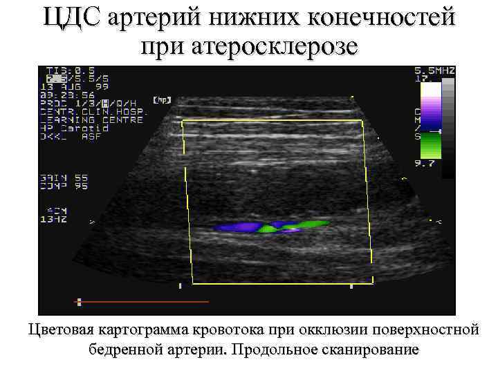 Дуплексное сканирование артерий нижних конечностей. ЦДС артерий нижних конечностей что это. УЗИ периферических сосудов. Атеросклероз артерий нижних конечностей на УЗИ. УЗИ бедренной артерии.