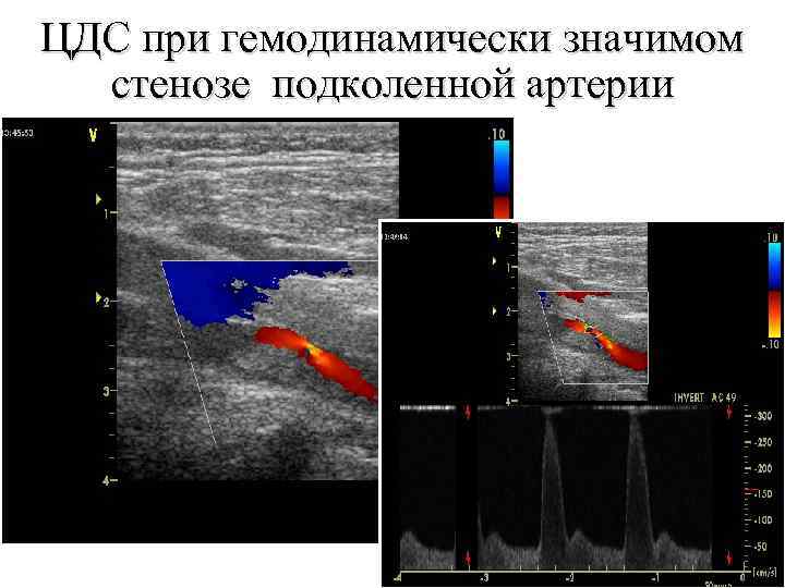 Окклюзия подколенной артерии. Гемодинамически значимые стенозы артерий. Гемодинамически значимый стеноз. Цветное дуплексное сканирование. Стеноз подколенной артерии.