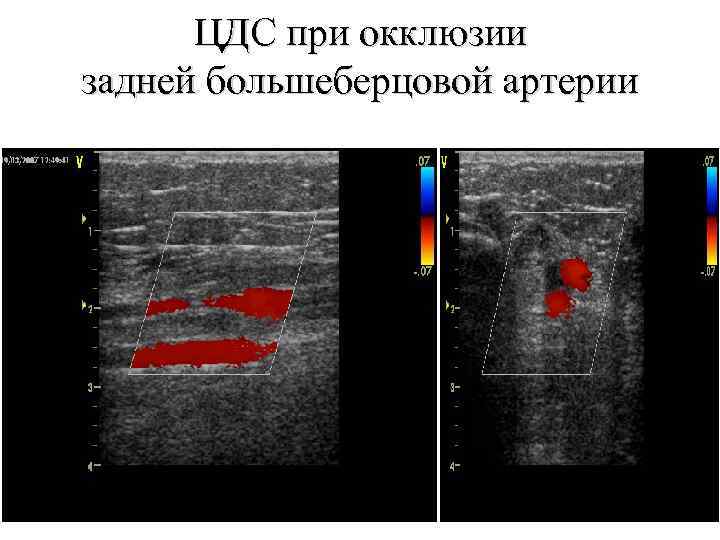 ЦДС при окклюзии задней большеберцовой артерии 