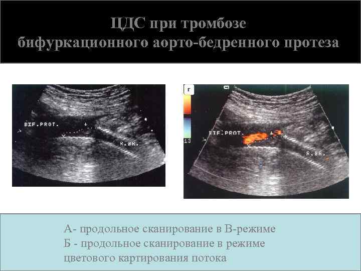 ЦДС при тромбозе бифуркационного аорто-бедренного протеза А- продольное сканирование в В-режиме Б - продольное