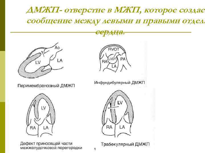 ДМЖП- отверстие в МЖП, которое создает сообщение между левыми и правыми отдела сердца. 