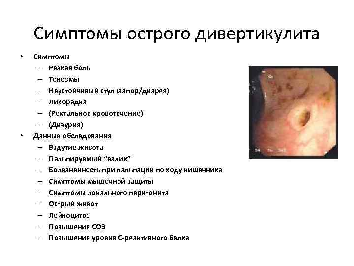 Симптомы острого дивертикулита • • Симптомы – Резкая боль – Тенезмы – Неустойчивый стул