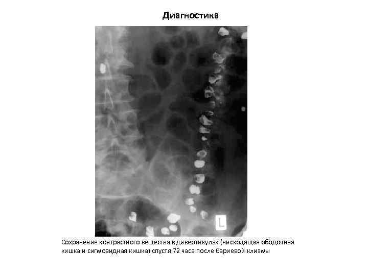 Диагностика Сохранение контрастного вещества в дивертикулах (нисходящая ободочная кишка и сигмовидная кишка) спустя 72