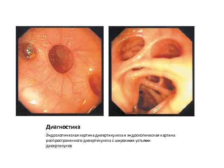 Диагностика Эндоскопическая картина дивертикулеза и эндоскопическая картина распространенного дивертикулеза с широкими устьями дивертикулов 