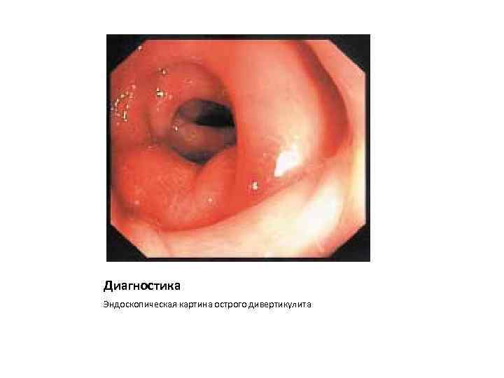 Диагностика Эндоскопическая картина острого дивертикулита 