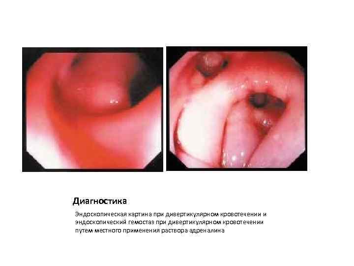 Диагностика Эндоскопическая картина при дивертикулярном кровотечении и эндоскопический гемостаз при дивертикулярном кровотечении путем местного