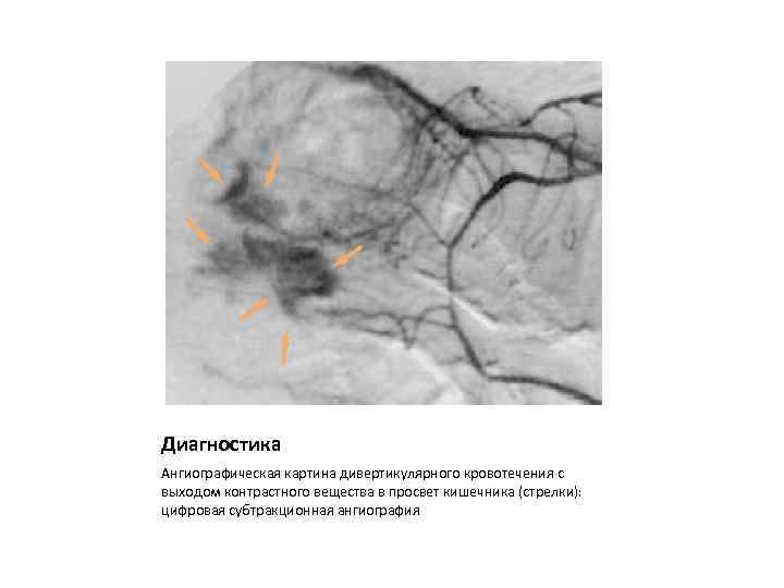 Диагностика Ангиографическая картина дивертикулярного кровотечения с выходом контрастного вещества в просвет кишечника (стрелки): цифровая