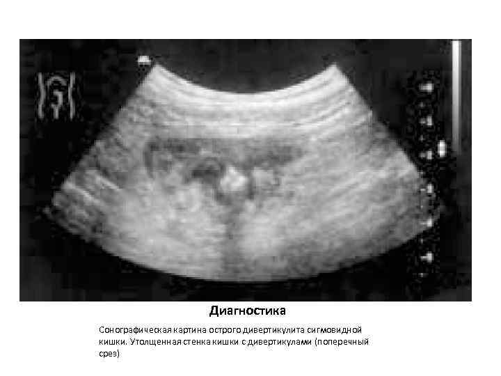 Диагностика Сонографическая картина острого дивертикулита сигмовидной кишки. Утолщенная стенка кишки с дивертикулами (поперечный срез)