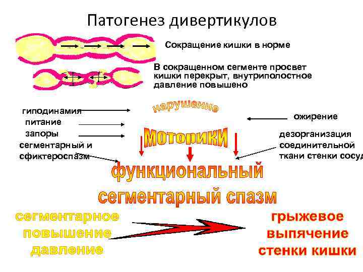 Патогенез дивертикулов Сокращение кишки в норме В сокращенном сегменте просвет кишки перекрыт, внутриполостное давление