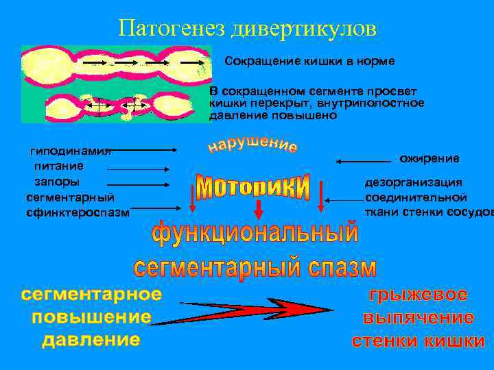 Патогенез дивертикулов Сокращение кишки в норме В сокращенном сегменте просвет кишки перекрыт, внутриполостное давление