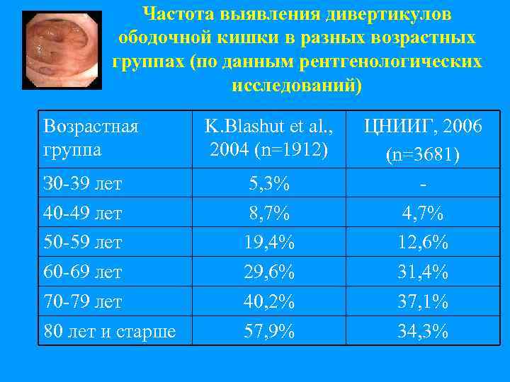 Частота выявления дивертикулов ободочной кишки в разных возрастных группах (по данным рентгенологических исследований) Возрастная