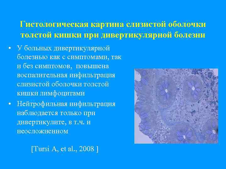 Гистологическая картина слизистой оболочки толстой кишки при дивертикулярной болезни • У больных дивертикулярной болезнью