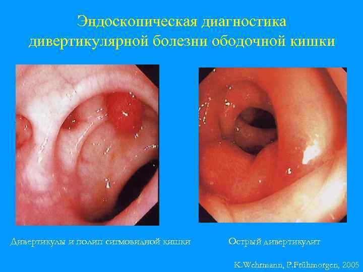 Эндоскопическая диагностика дивертикулярной болезни ободочной кишки Дивертикулы и полип сигмовидной кишки Острый дивертикулит K.