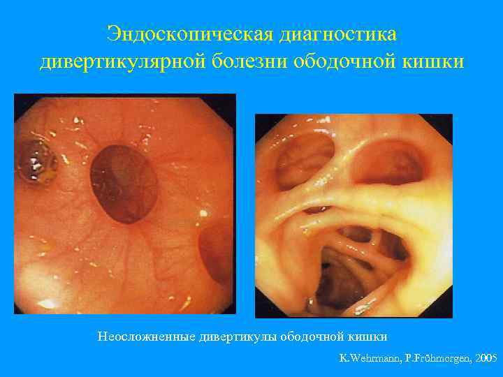 Эндоскопическая диагностика дивертикулярной болезни ободочной кишки Неосложненные дивертикулы ободочной кишки K. Wehrmann, P. Frühmorgen,