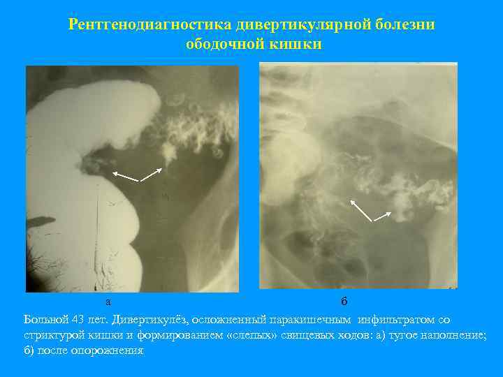 Рентгенодиагностика дивертикулярной болезни ободочной кишки а б Больной 43 лет. Дивертикулёз, осложненный паракишечным инфильтратом