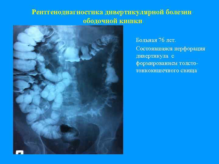 Рентгенодиагностика дивертикулярной болезни ободочной кишки Больная 76 лет. Состоявшаяся перфорация дивертикула с формированием толстотонкокишечного