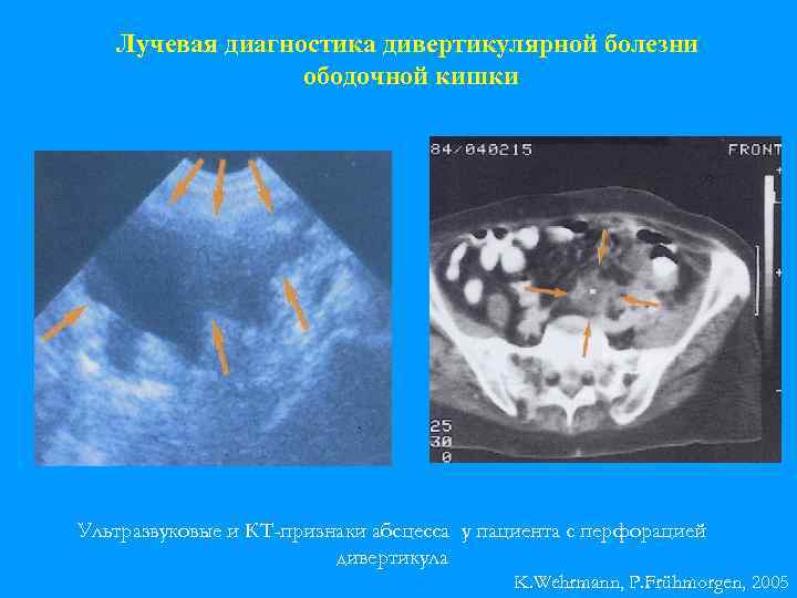 Лучевая диагностика дивертикулярной болезни ободочной кишки Ультразвуковые и КТ-признаки абсцесса у пациента с перфорацией