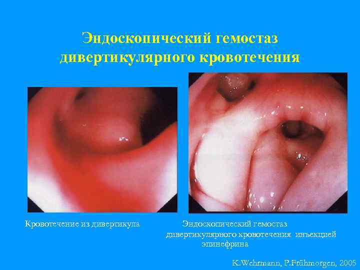 Эндоскопический гемостаз дивертикулярного кровотечения Кровотечение из дивертикула Эндоскопический гемостаз дивертикулярного кровотечения инъекцией эпинефрина K.