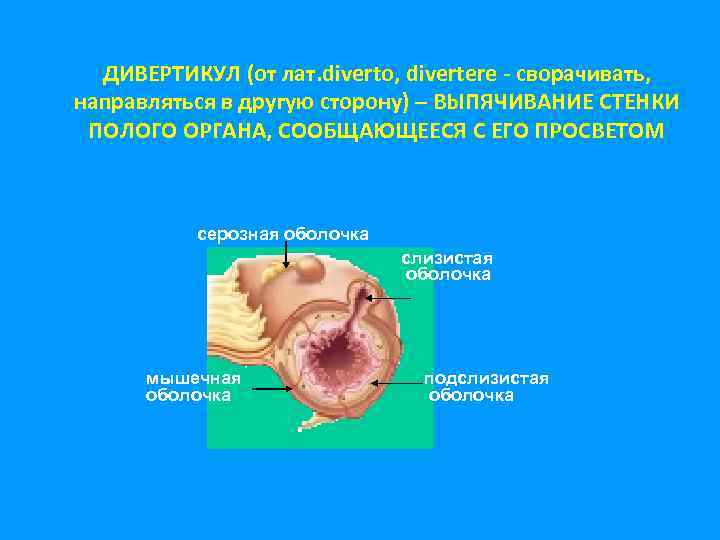 ДИВЕРТИКУЛ (от лат. diverto, divertere - сворачивать, направляться в другую сторону) – ВЫПЯЧИВАНИЕ СТЕНКИ