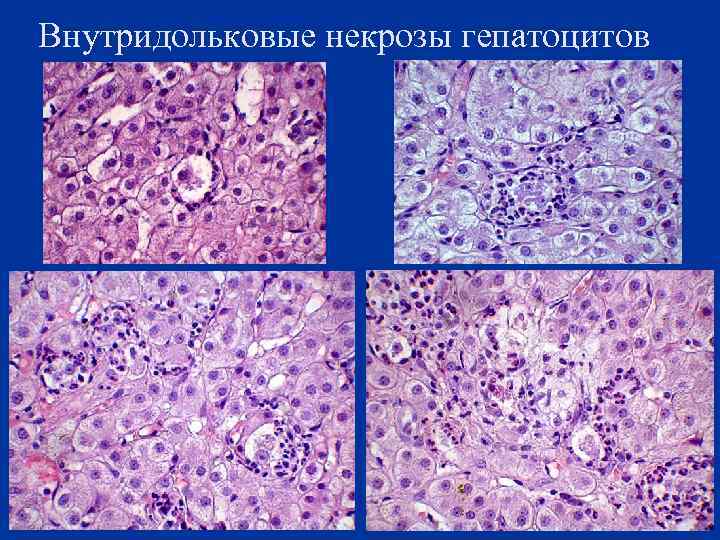 Внутридольковые некрозы гепатоцитов 