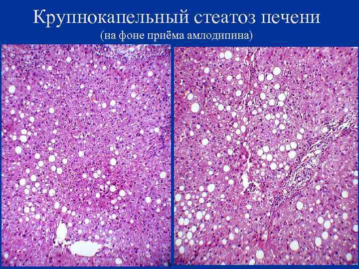 Крупнокапельный стеатоз печени (на фоне приёма амлодипина) 