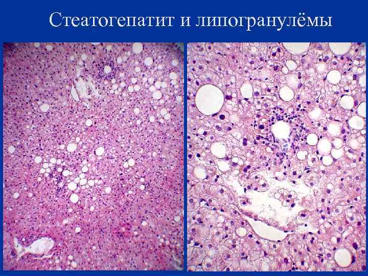 Стеатогепатит и липогранулёмы 