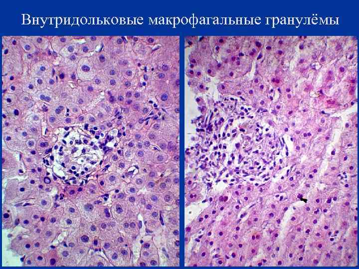 Внутридольковые макрофагальные гранулёмы 