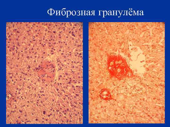 Фиброзная гранулёма 