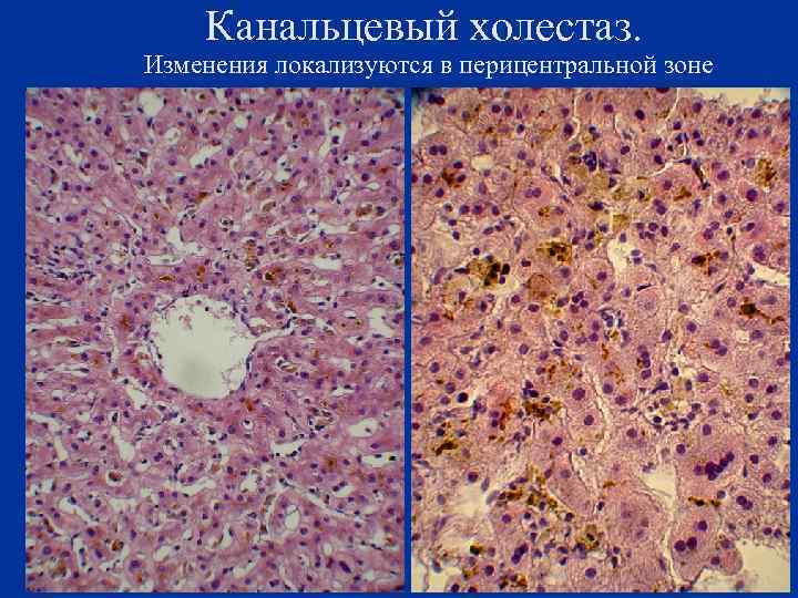 Канальцевый холестаз. Изменения локализуются в перицентральной зоне 