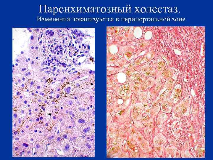 Паренхиматозный холестаз. Изменения локализуются в перипортальной зоне 