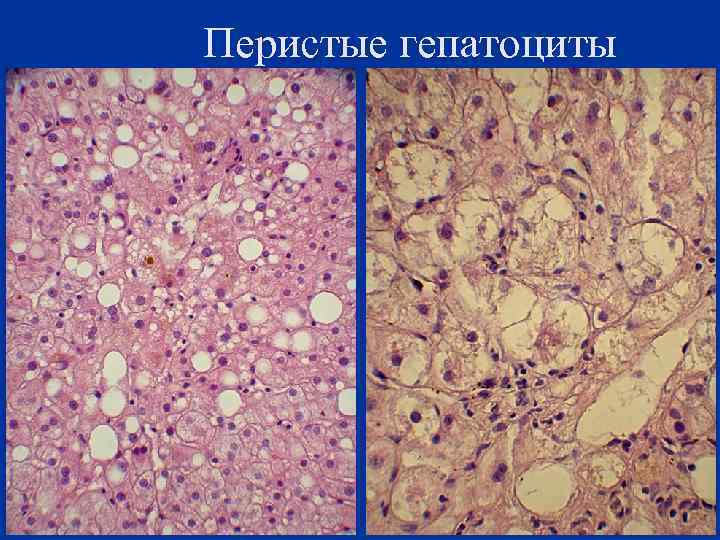 Перистые гепатоциты 