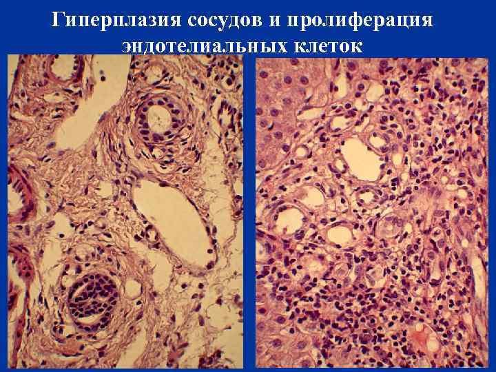 Гиперплазия сосудов и пролиферация эндотелиальных клеток 