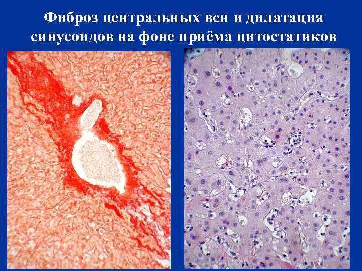 Фиброз центральных вен и дилатация синусоидов на фоне приёма цитостатиков 