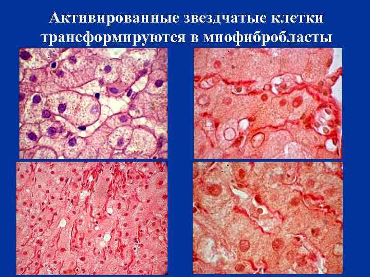 Активированные звездчатые клетки трансформируются в миофибробласты 