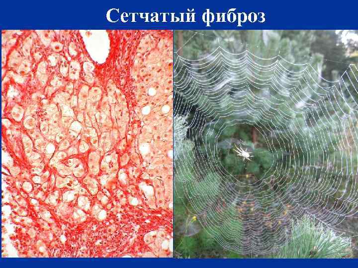 Сетчатый фиброз 