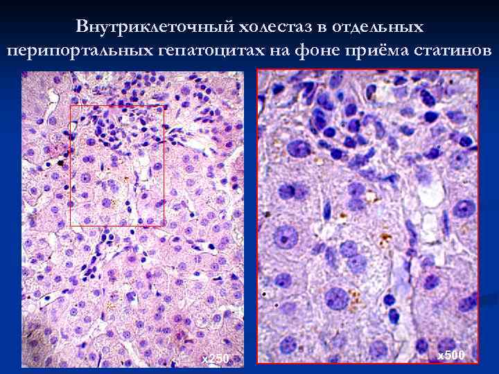 Внутриклеточный холестаз в отдельных перипортальных гепатоцитах на фоне приёма статинов х250 х500 