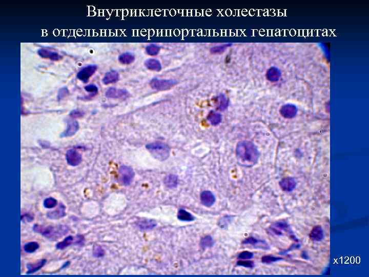 Внутриклеточные холестазы в отдельных перипортальных гепатоцитах х1200 
