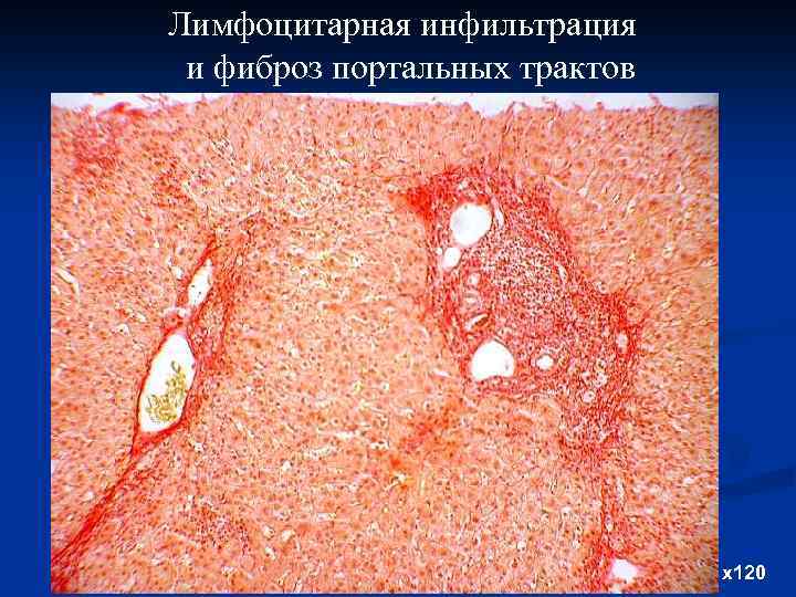 Лимфоцитарная инфильтрация и фиброз портальных трактов х120 