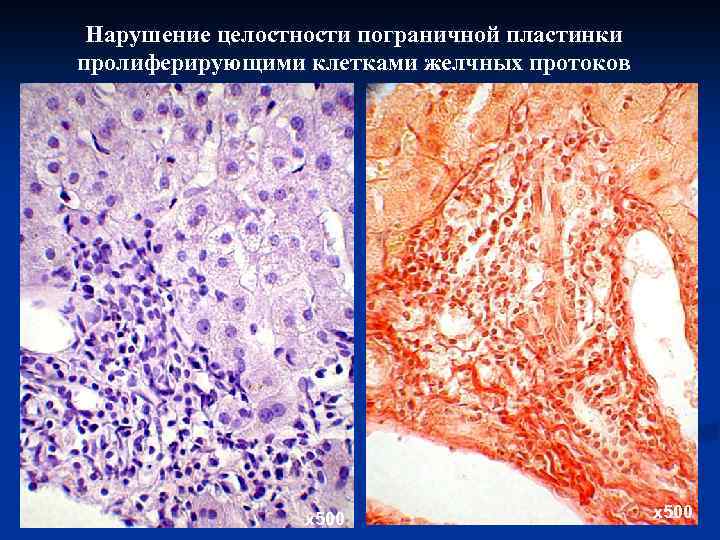 Нарушение целостности пограничной пластинки пролиферирующими клетками желчных протоков х500 