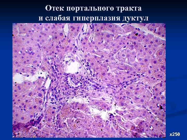 Отек портального тракта и слабая гиперплазия дуктул х250 
