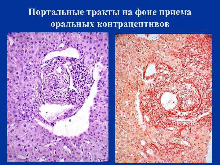 Портальные тракты на фоне приема оральных контрацептивов 